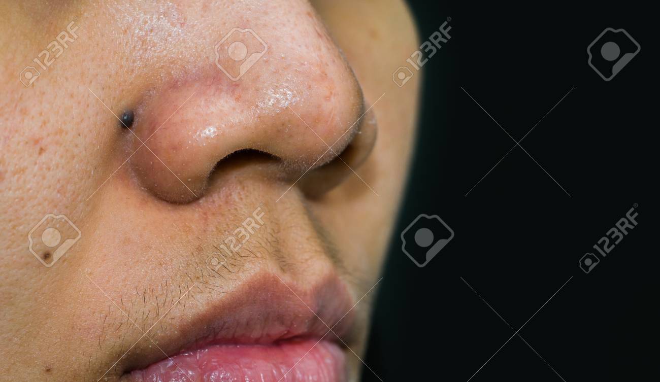 laser blackhead removal