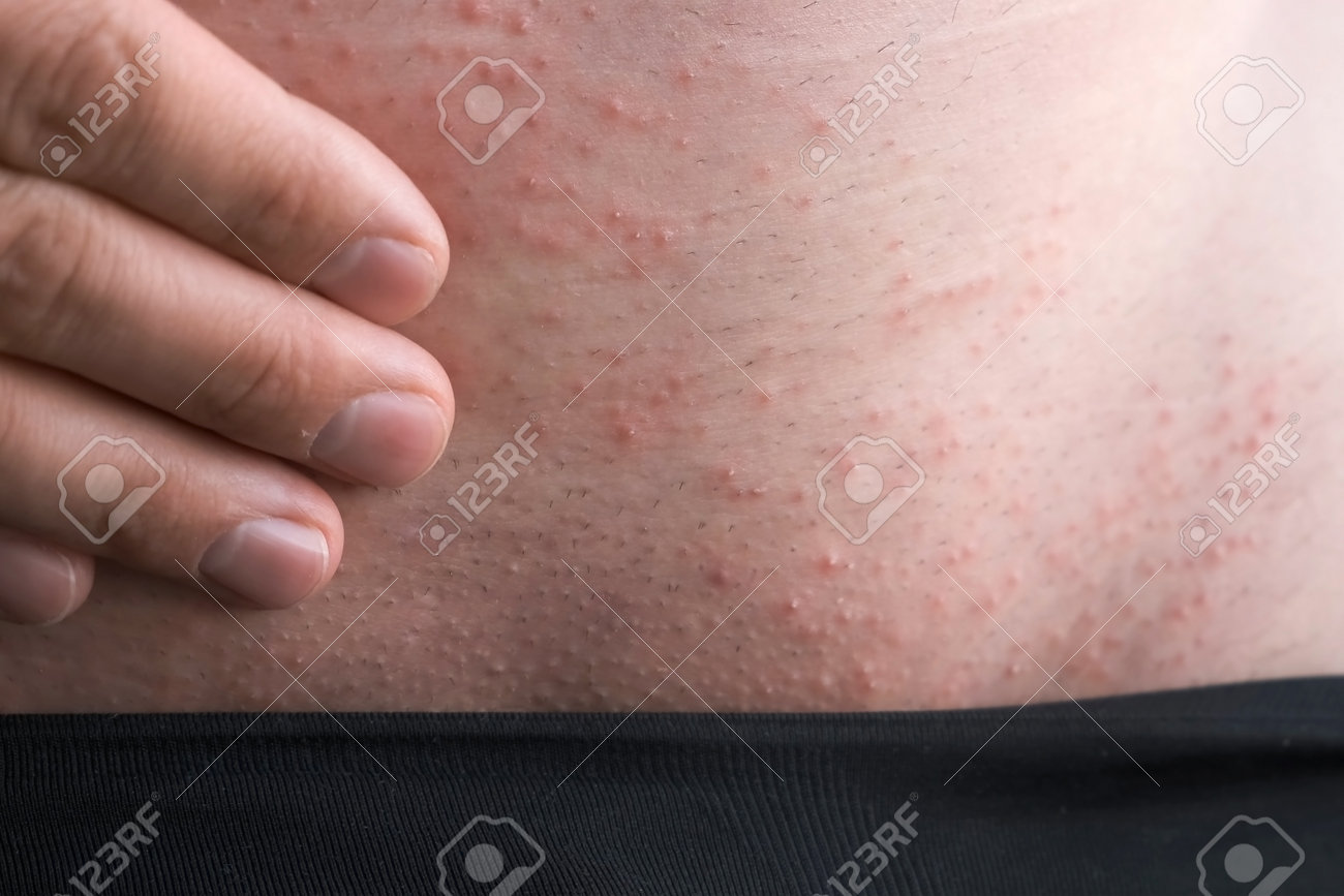 https://previews.123rf.com/images/familylifestyle/familylifestyle2104/familylifestyle210400797/167963865-man-is-scratching-small-spots-rash-on-his-abdomen-by-hand-closeup-view-part-of-body-in-black-pants.jpg