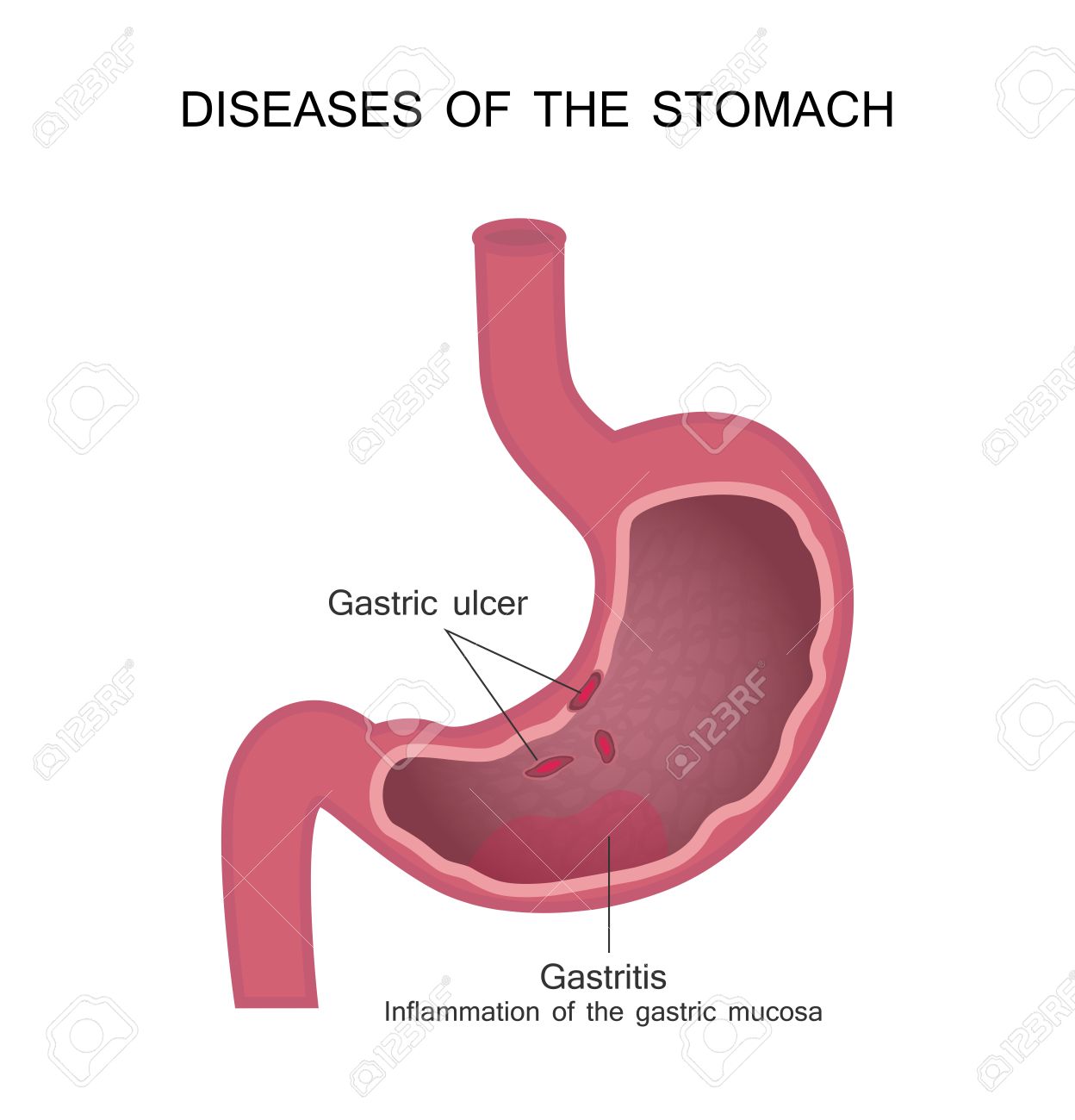 gastritis y ulcera peptica diagnostico