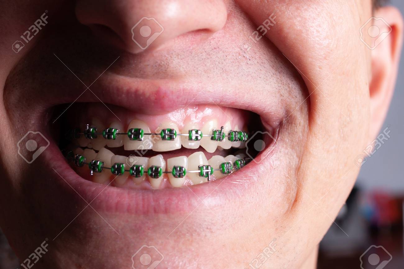 Crooked Teeth And Metal Braces 