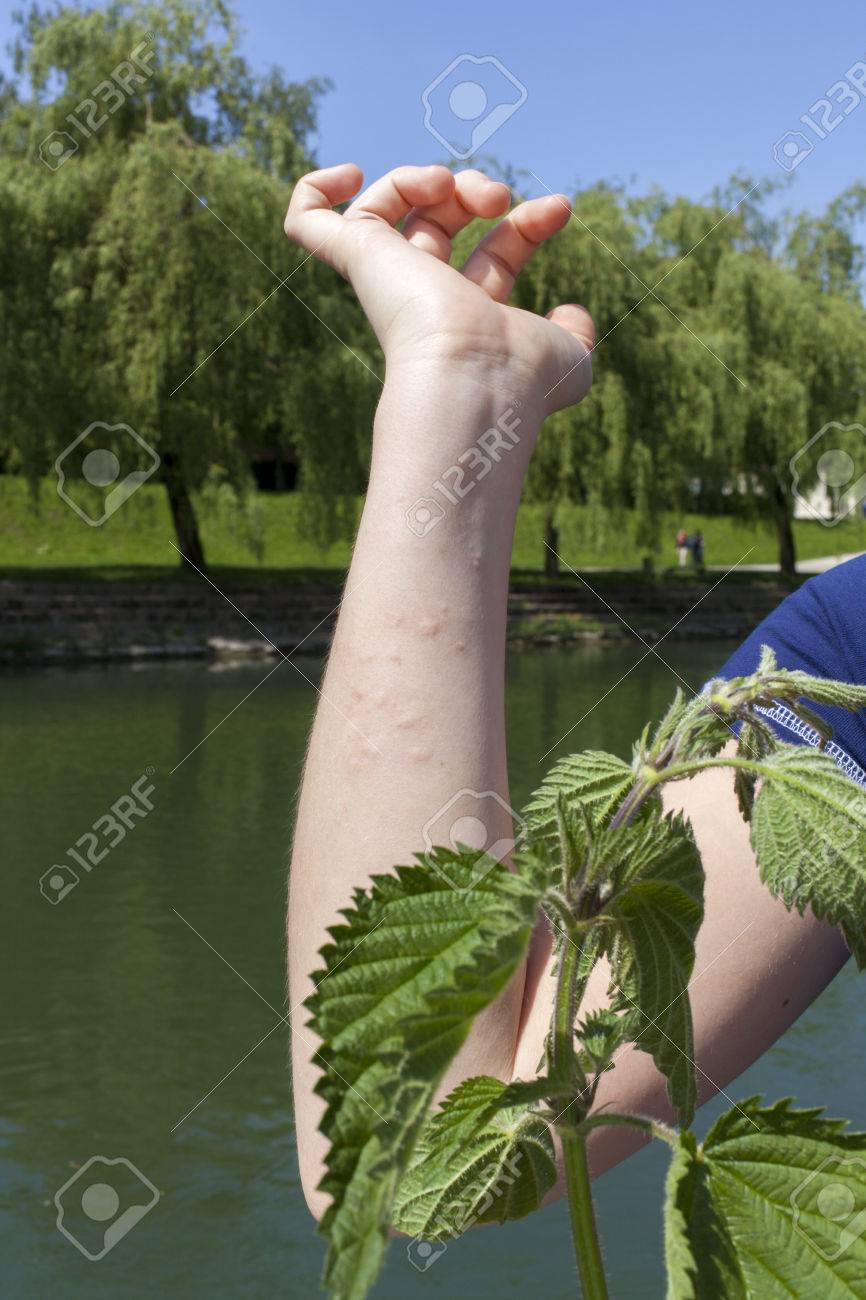 Acute Allergic Reaction After Touching Stinging Nettle Leaves Series Of High Resolution Photos Stock Photo Picture And Royalty Free Image Image 27997543