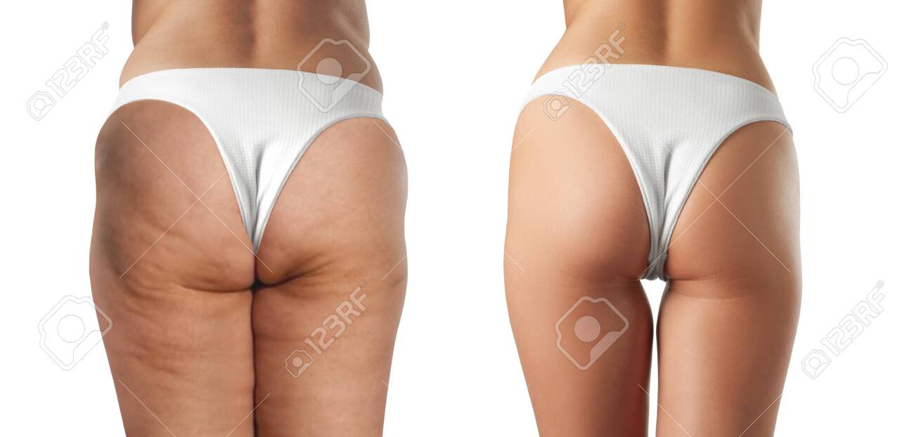 anti cellulite treatment