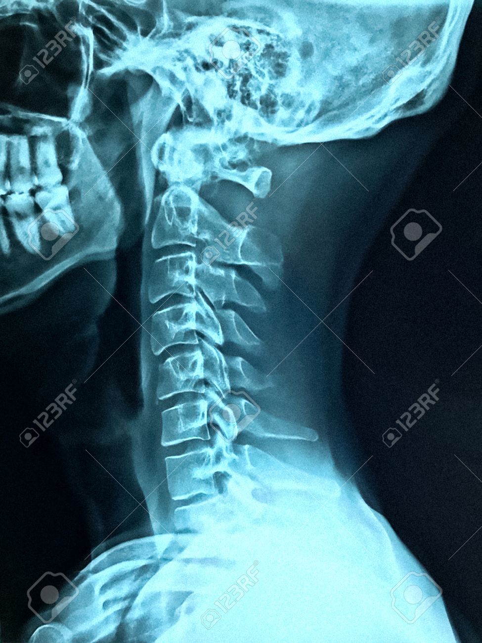 que es un esguince cervical