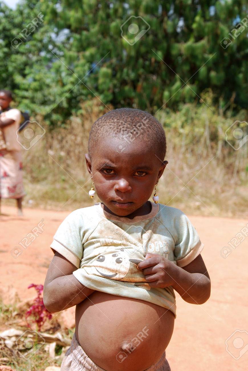 Imagenes Niños De Africa En Desnutricion 08 De Agosto 2014 - Pueblo De Pomerini - Tanzania - África - Un Niño No  Identificado Vestido Con Ropas Africanas Pobres, Muestra Su Vientre  Hinchado De Los Síntomas De La Desnutrición