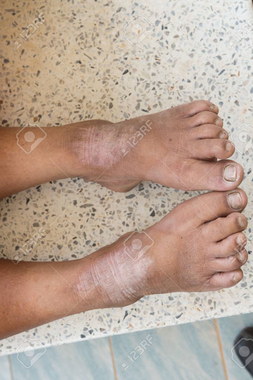足の皮膚疾患 の写真素材 画像素材 Image
