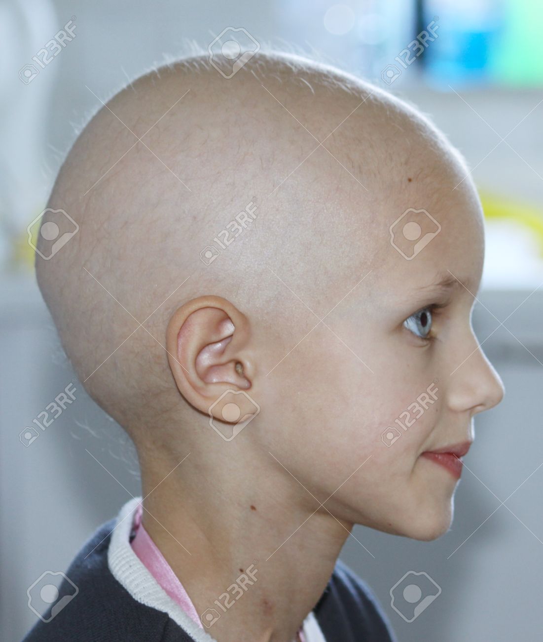 がん化学療法による脱毛を示す白人の子供のプロフィール の写真素材 画像素材 Image がん化学療法による脱毛を示す白人の子供のプロフィール の写真素材 画像素材 Image