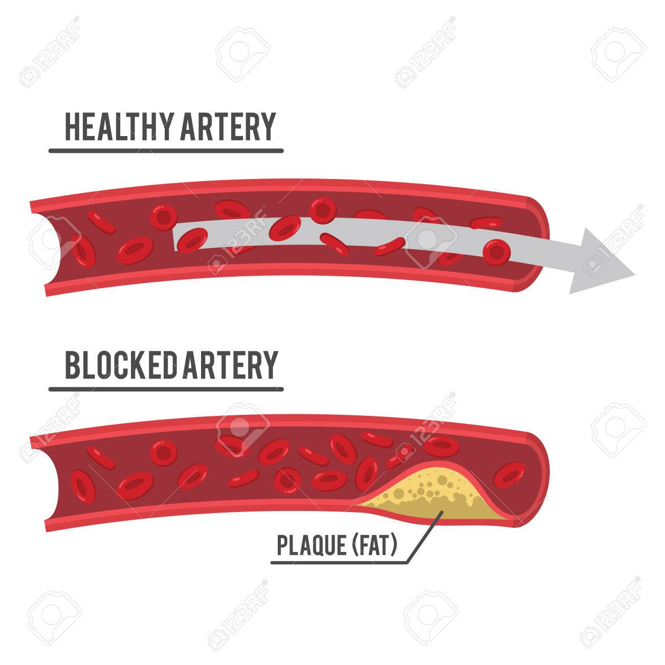 https://previews.123rf.com/images/funwayillustration/funwayillustration1701/funwayillustration170100045/68462357-healthy-artery-and-blocked-artery.jpg