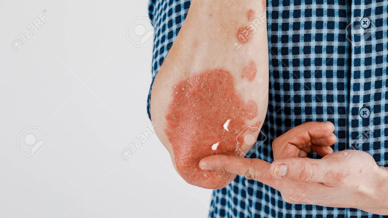 skin emollients eczema