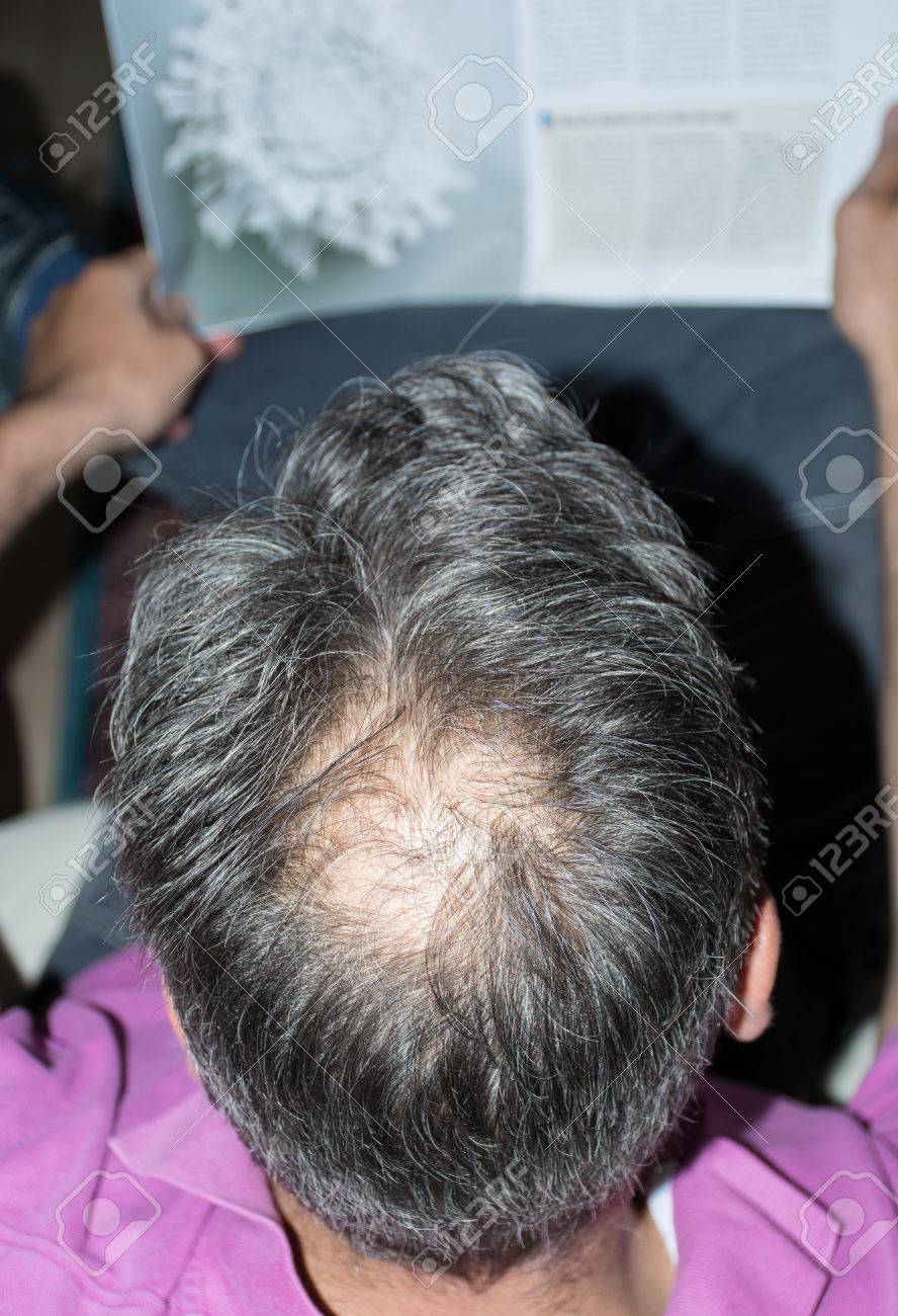 Calvitie homme derriere Clearance