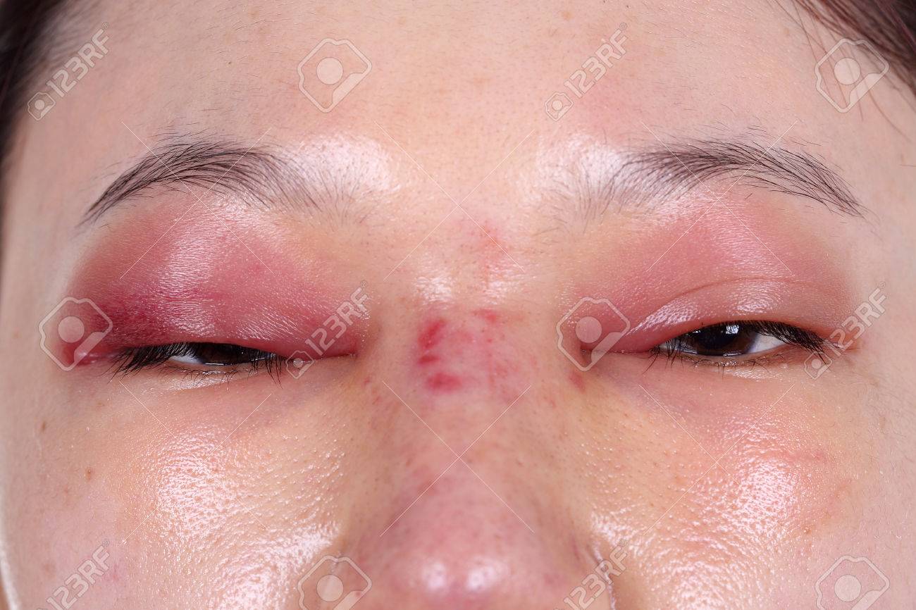 upper eye lid and nose swell after nose job plastic surgery - 37745393 upper eye lid and nose swell after nose job plastic surgery - 37745393