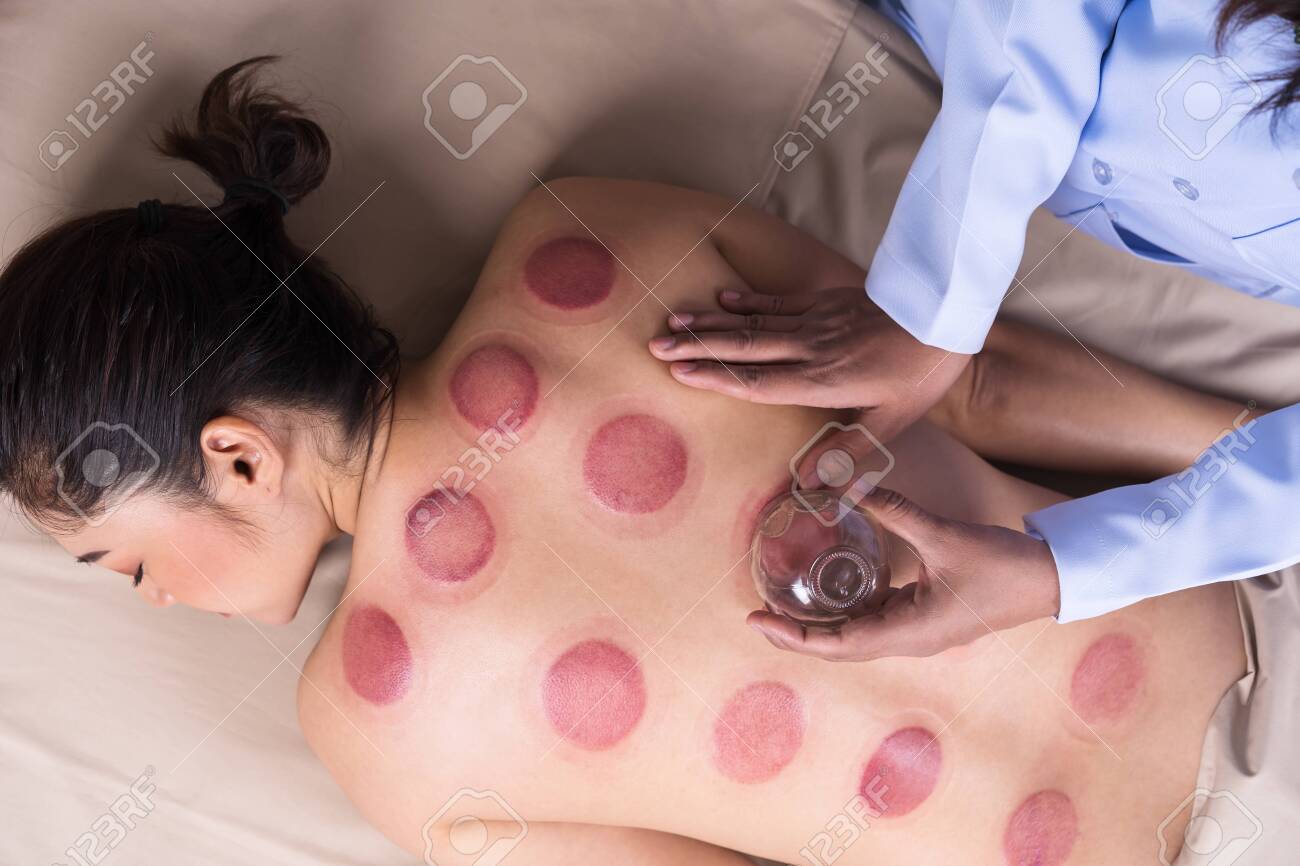 young woman receiving cupping treatment on back - 129896325 young woman receiving cupping treatment on back - 129896325