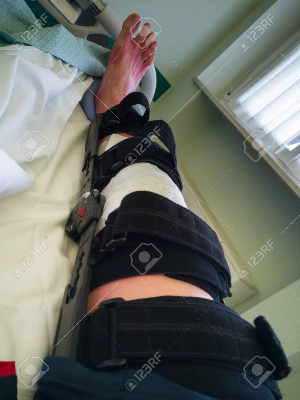 Human Leg With Patches And Orthopedic Brace After Anterior Cruciate Stock Photo Picture And Royalty Free Image Image