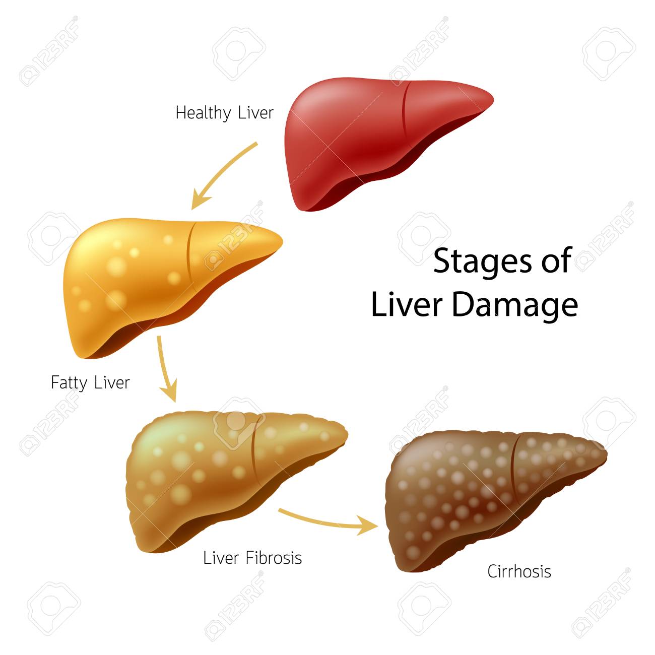 https://previews.123rf.com/images/gloly67/gloly671804/gloly67180400034/99636813-stages-of-liver-damage-liver-disease-healthy-liver-fatty-liver-liver-fibrosis-and-cirrhosis.jpg