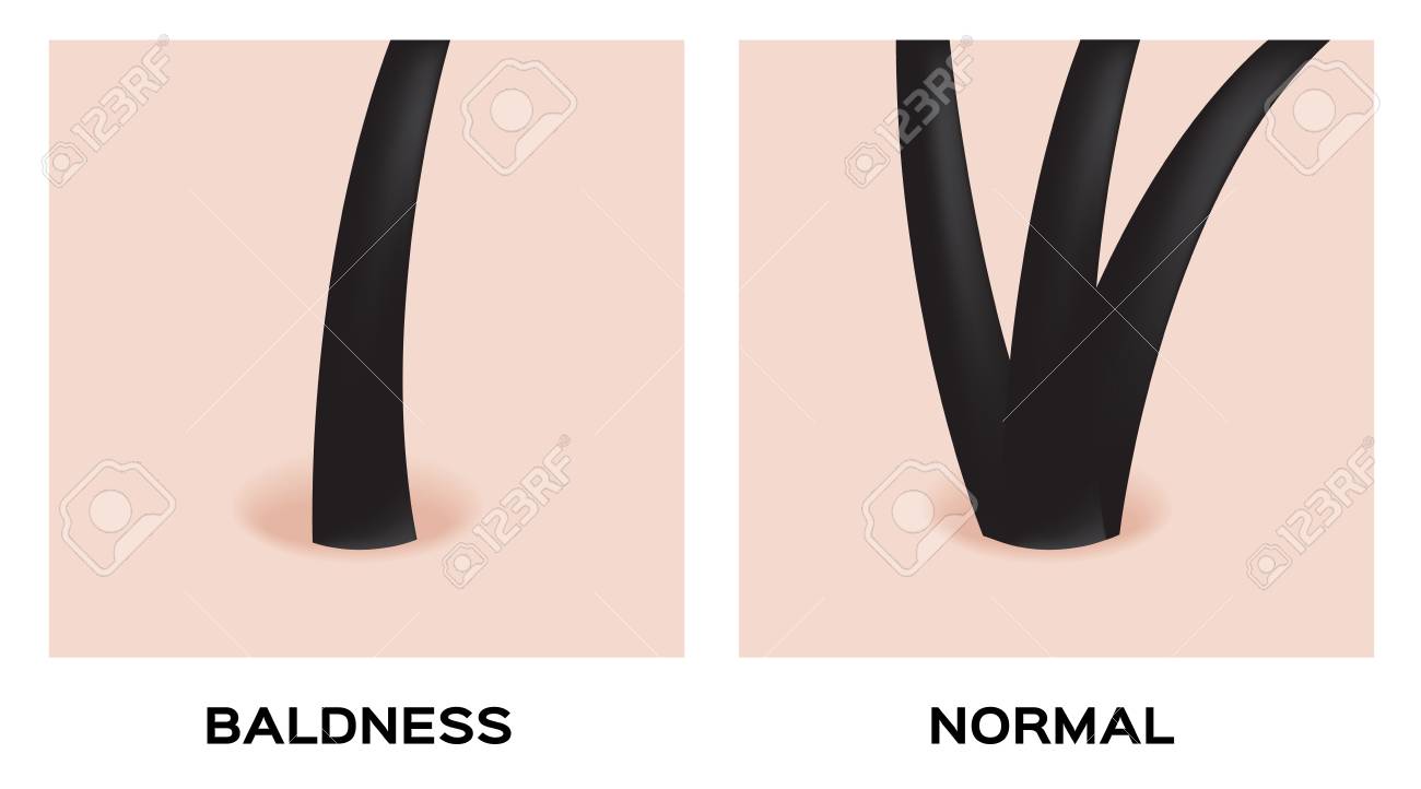 Hair Type Baldness And Normal Hair Vector Royalty Free Cliparts
