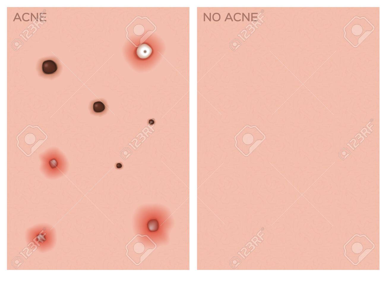 種類のにきびやにきび 開発の段階のベクトル イラスト のイラスト素材 ベクタ Image