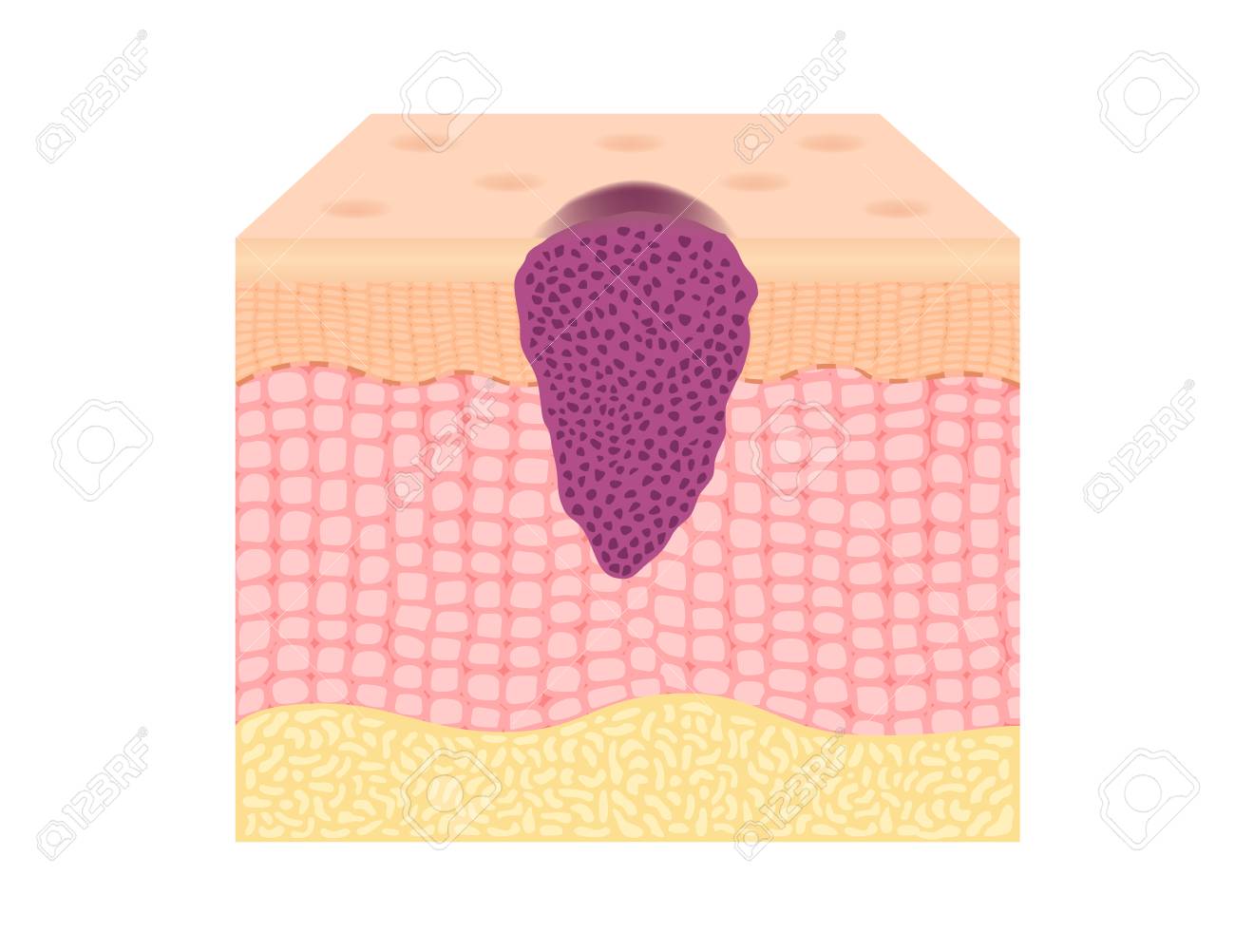 皮膚がん細胞成長腫瘍ベクトル のイラスト素材 ベクタ Image