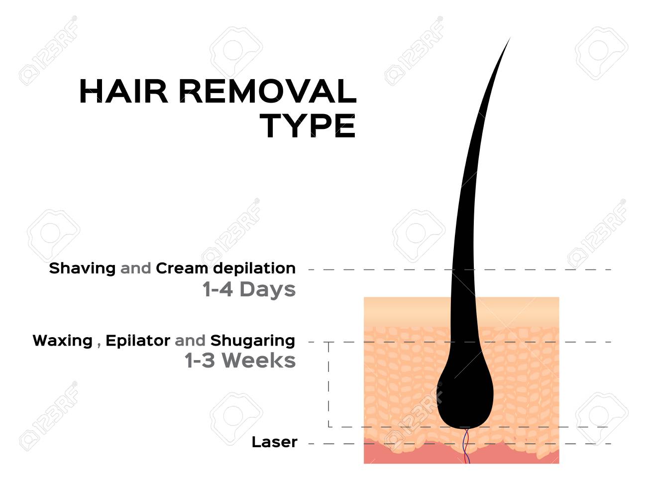 Hair Removal Type Vector Illustration Royalty Free Cliparts