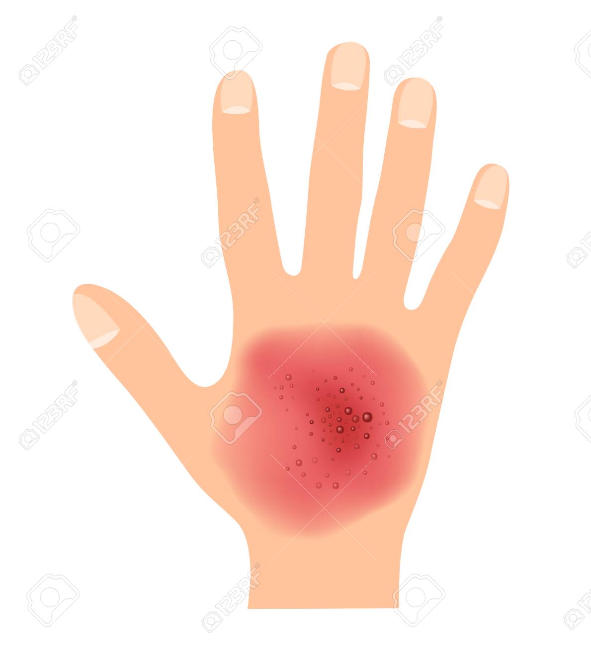 Rash On Hand Skin Vector Royalty Free Cliparts Vectors And Stock Illustration Image 106989647