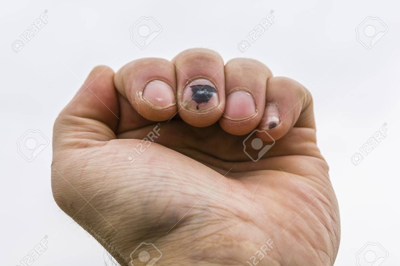 中指と人間の手の小指の爪下血腫 の写真素材 画像素材 Image 4691