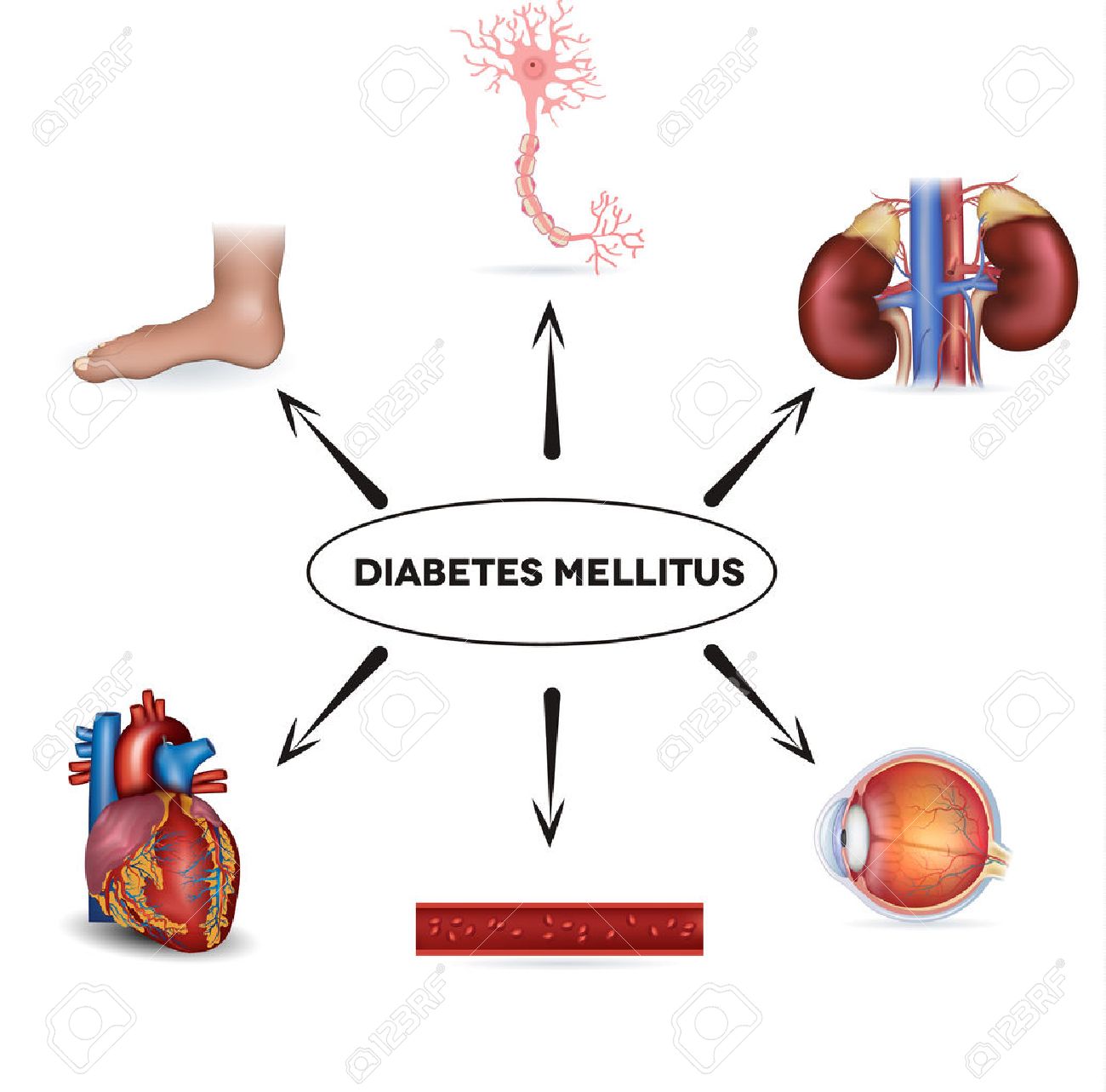 sistemas de órganos afectados por diabetes