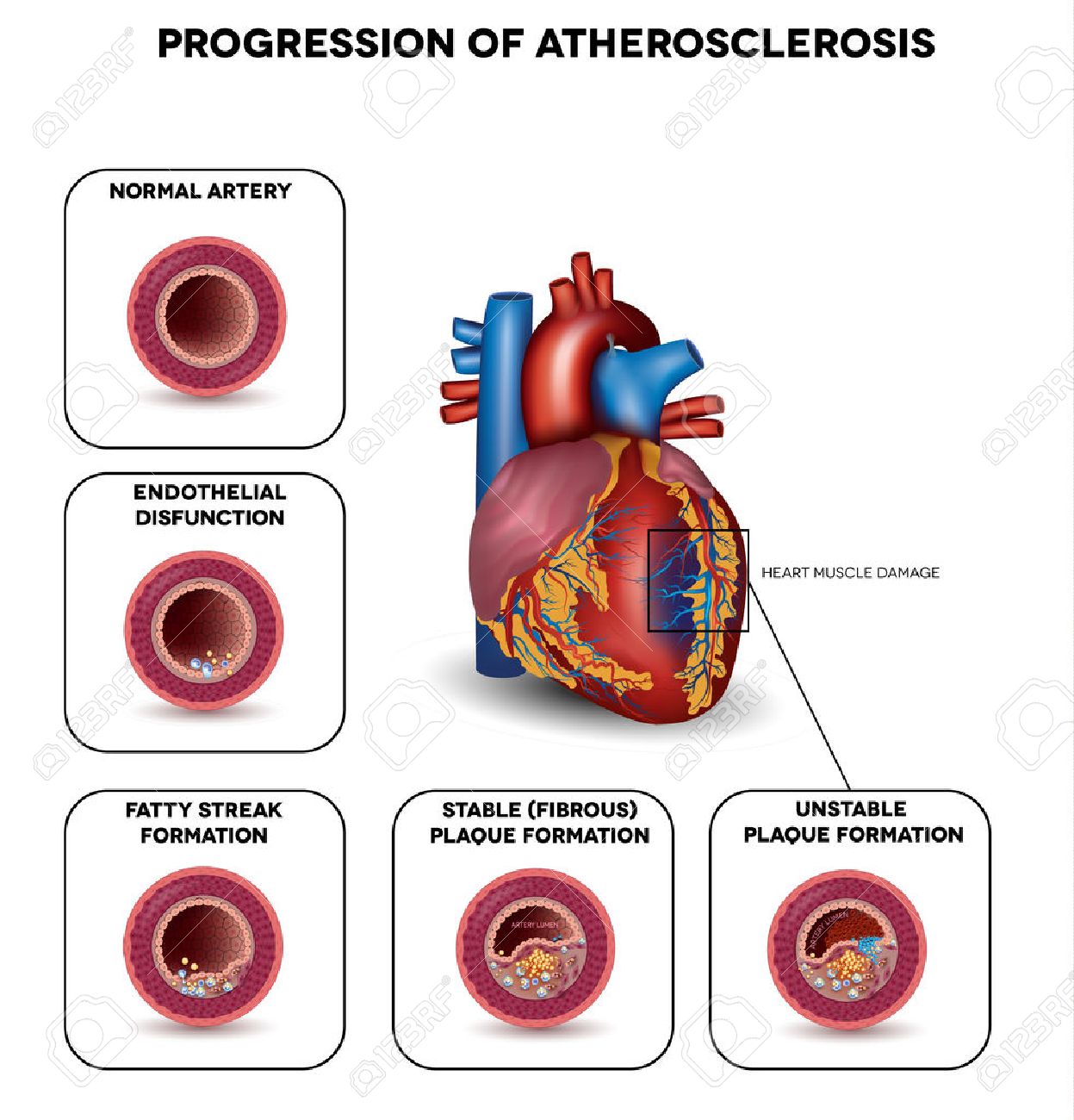 Fortschreiten Der Arteriosklerose Bis Herzinfarkt Herzmuskelschaden Durch Blutgerinnsel In Der Arterie Sehr Detaillierte Darstellung Der Fettstreifenbildung Weisse Blutzellen Infiltration Blutgerinnselbildung Usw Lizenzfrei Nutzbare Vektorgrafiken