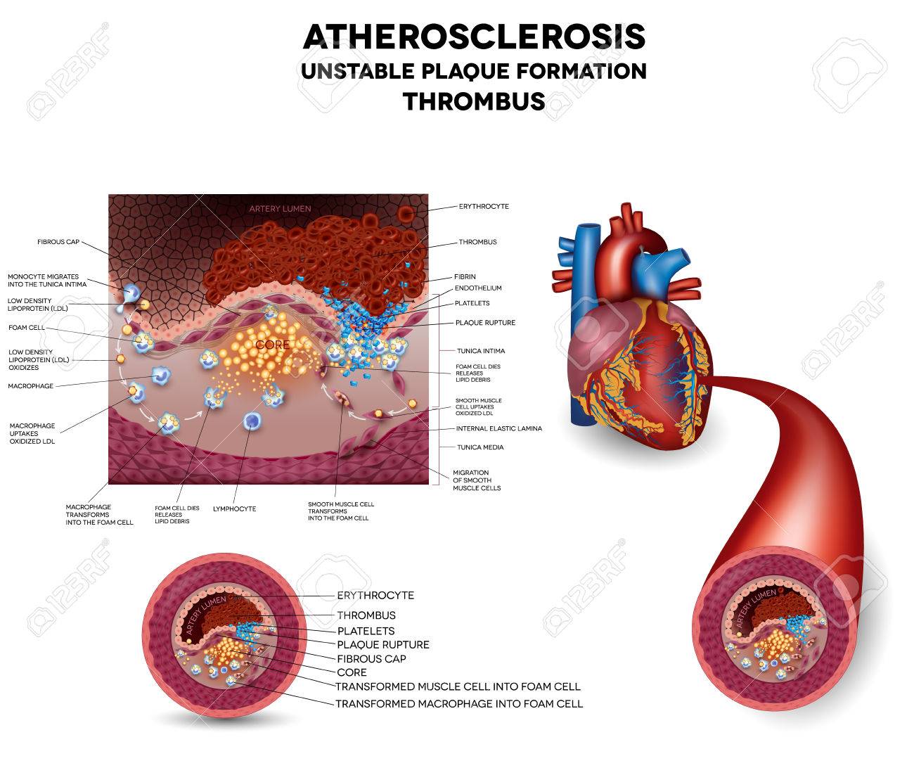 Caillot De Sang Rupture De La Plaque Et La Formation De Caillots Sanguins Lesions Du Muscle Cardiaque Illustration Tres Detaillee Clip Art Libres De Droits Vecteurs Et Illustration Image