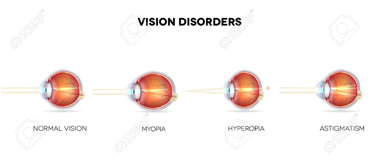 hyperopia myopia vision
