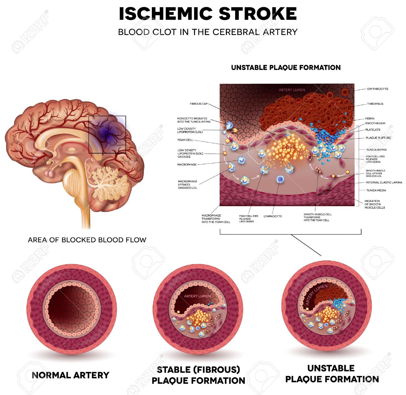 Isquemicas enfermedades cerebrovasculares