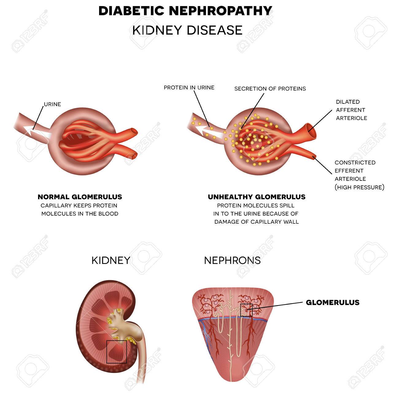 enfermedad renal causada por diabetes enfermedad renal causada por diabetes