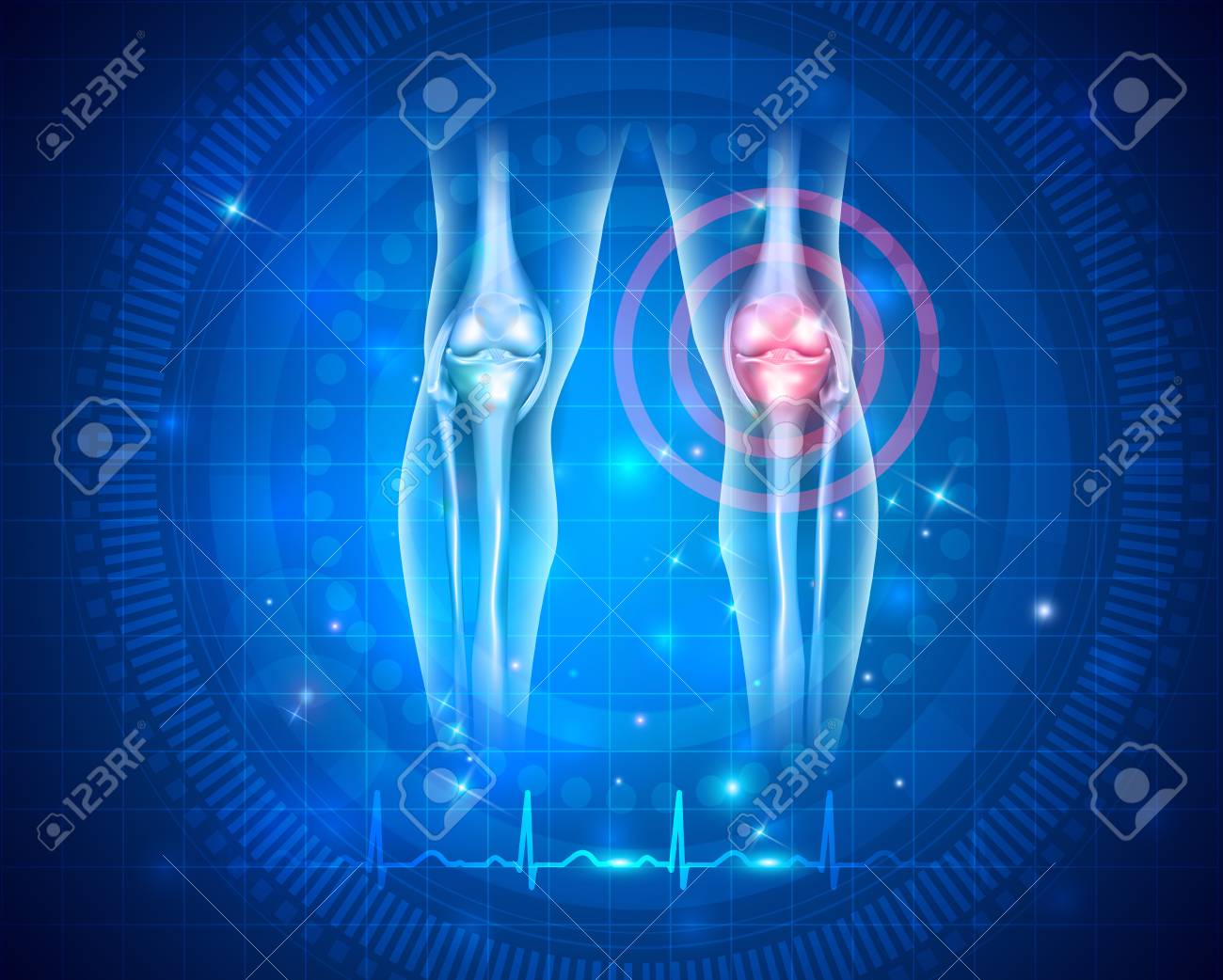 Damaged joint and normal cardiogram at the bottom, joint health care concept - 87283081 Damaged joint and normal cardiogram at the bottom, joint health care concept - 87283081