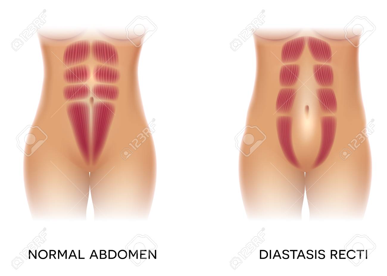 Diastasis recti also known as abdominal separation, it is common among pregnant women. There is a gap between the rectus abdominis muscles. - 111921614 Diastasis recti also known as abdominal separation, it is common among pregnant women. There is a gap between the rectus abdominis muscles. - 111921614