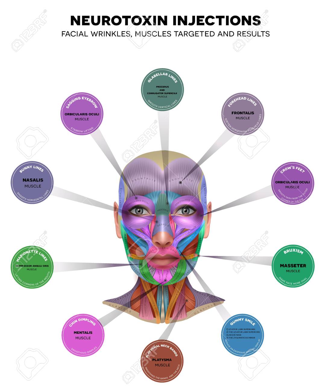 Injections for facial wrinkles. Common types of facial wrinkles. Neurotoxin injections treatment areas, muscles targeted and results. - 139945293 Injections for facial wrinkles. Common types of facial wrinkles. Neurotoxin injections treatment areas, muscles targeted and results. - 139945293