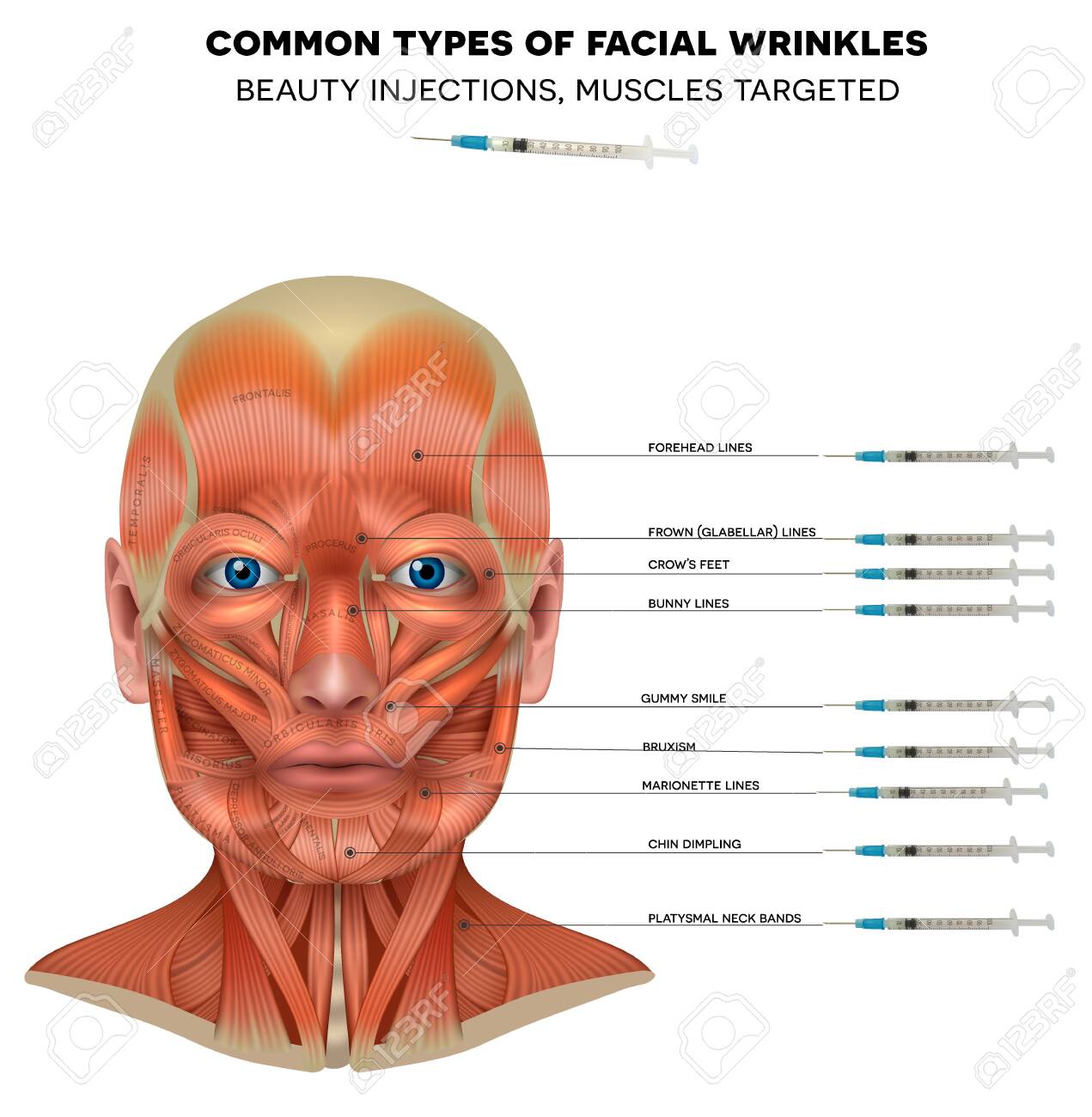 Facial injections info poster, male model face muscles anatomy. Common types of facial wrinkles. Neurotoxin injections treatment areas, - 140557797 Facial injections info poster, male model face muscles anatomy. Common types of facial wrinkles. Neurotoxin injections treatment areas, - 140557797