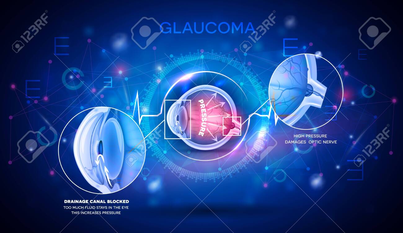 Glaucoma vision disorder abstract blue scientific background, detailed anatomy digital futuristic illustration - 141967864 Glaucoma vision disorder abstract blue scientific background, detailed anatomy digital futuristic illustration - 141967864