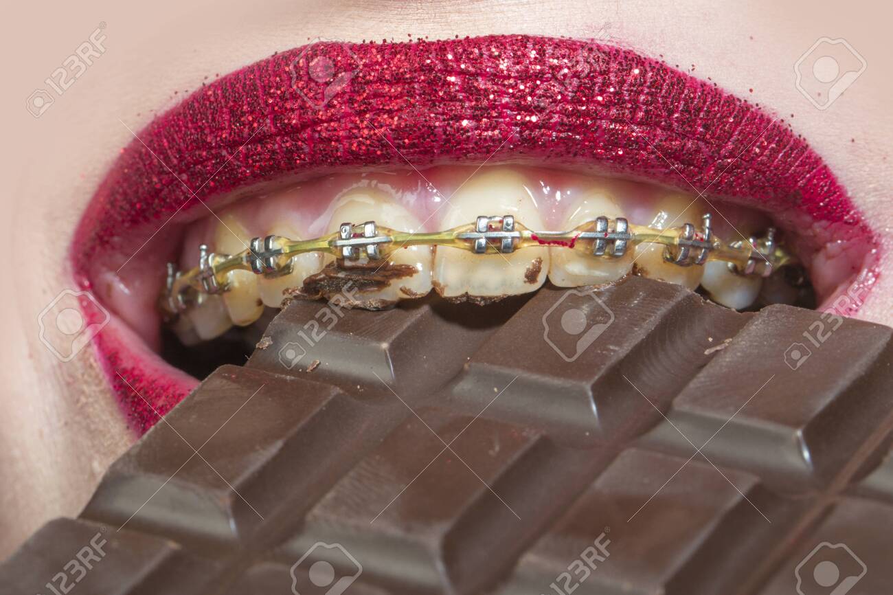 Braces And Chocolate. Dental Health, Dentistry And Stomatology. Teeth  Alignment. Sweet Unhealthy Food. Meals With Braces. Dessert For A Teenager.  Girl With A Red Shiny Lipstick Eats A Chocolate Bar. Stock Photo,