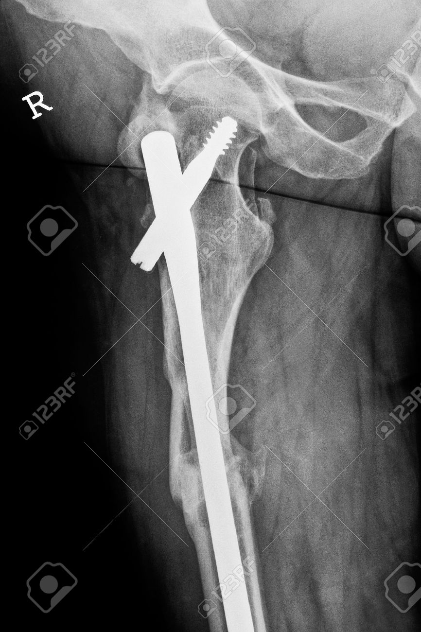 Postsurgical X-ray Image Shows An Osteosynthesis Of A Fractured Upper Leg  Through A Gamma Nail 免版權照片，圖片，畫像及圖片庫. Image 15063924