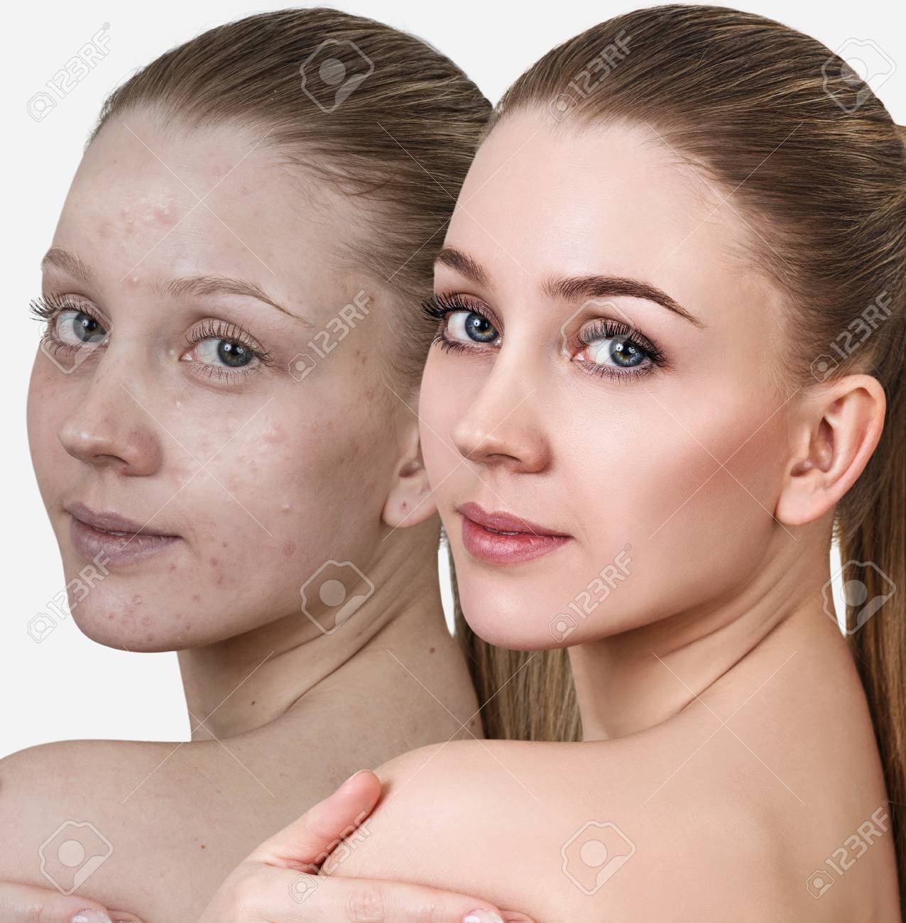 治療と化粧の前後の女性 の写真素材 画像素材 Image