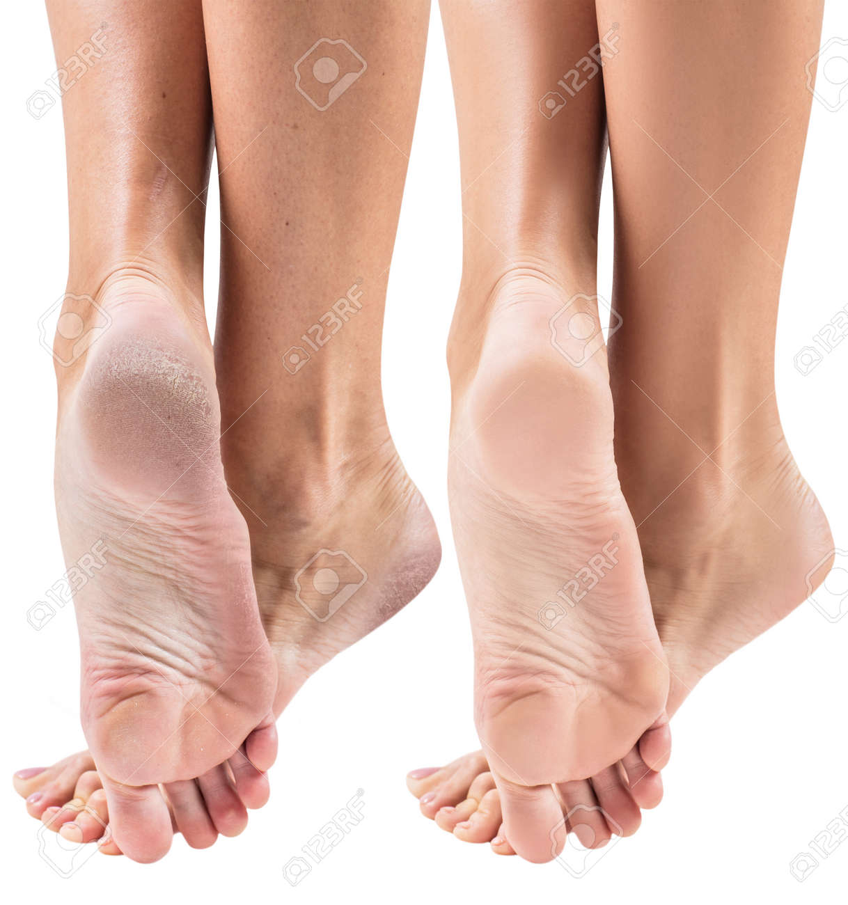 white dry skin on feet white dry skin on feet