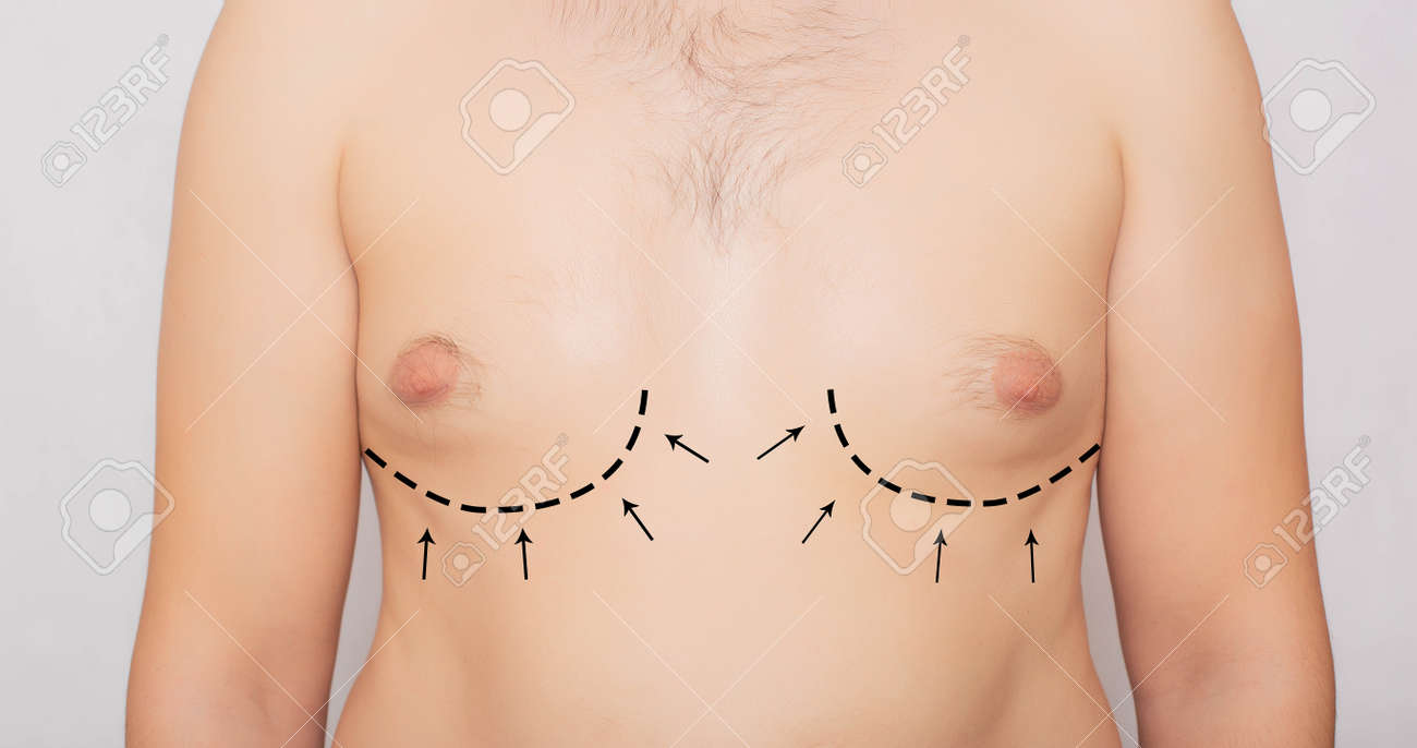 男性の体、男性の乳房のプラスチック、女性化乳房。男性の乳房の調整、形成外科の背景の写真素材・画像素材 Image 134069985