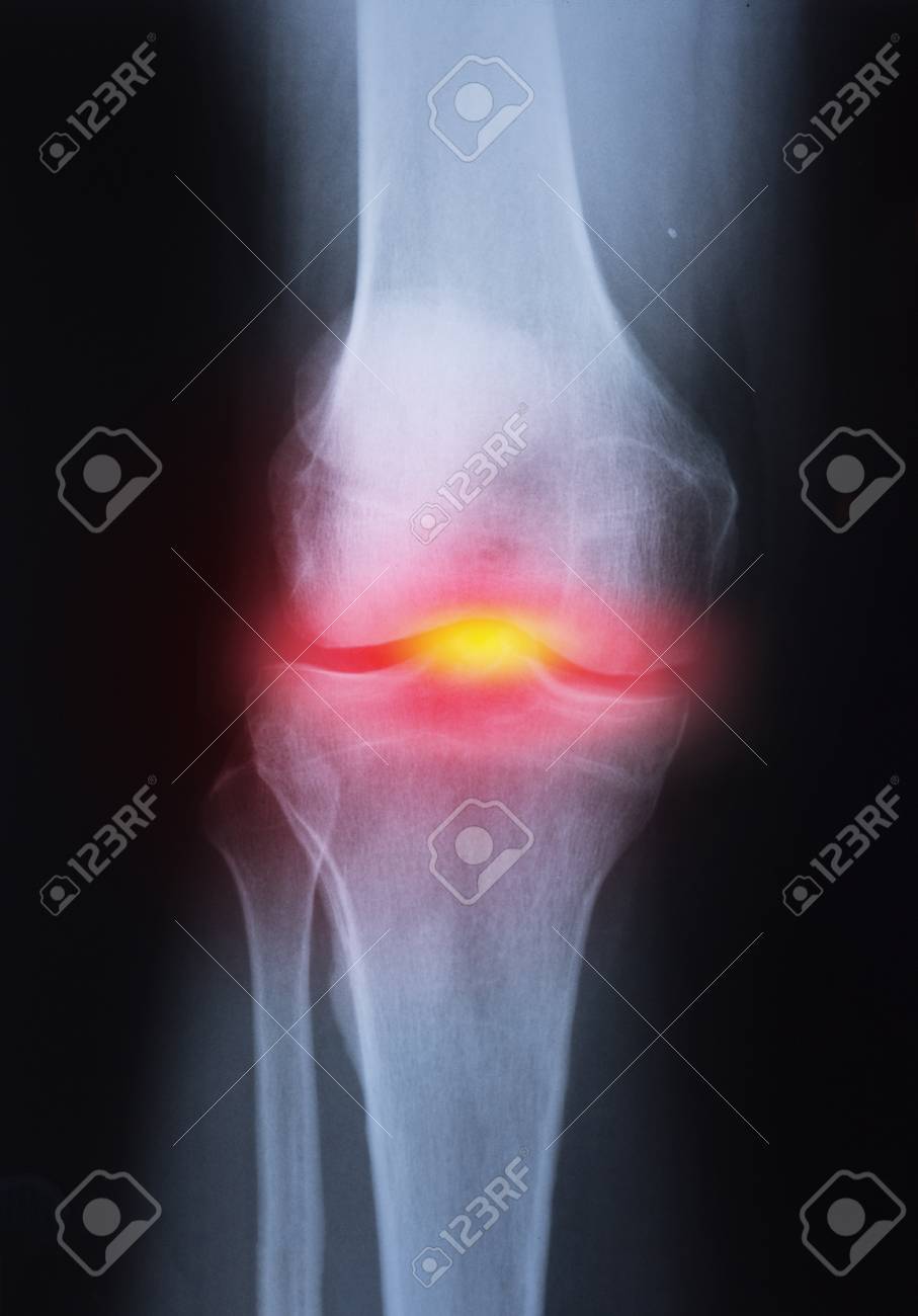 Medical x-ray knee joint image with arthritis ( Gout , Rheumatoid arthritis , Septic arthritis , Osteoarthritis knee ) - 114018846 Medical x-ray knee joint image with arthritis ( Gout , Rheumatoid arthritis , Septic arthritis , Osteoarthritis knee ) - 114018846
