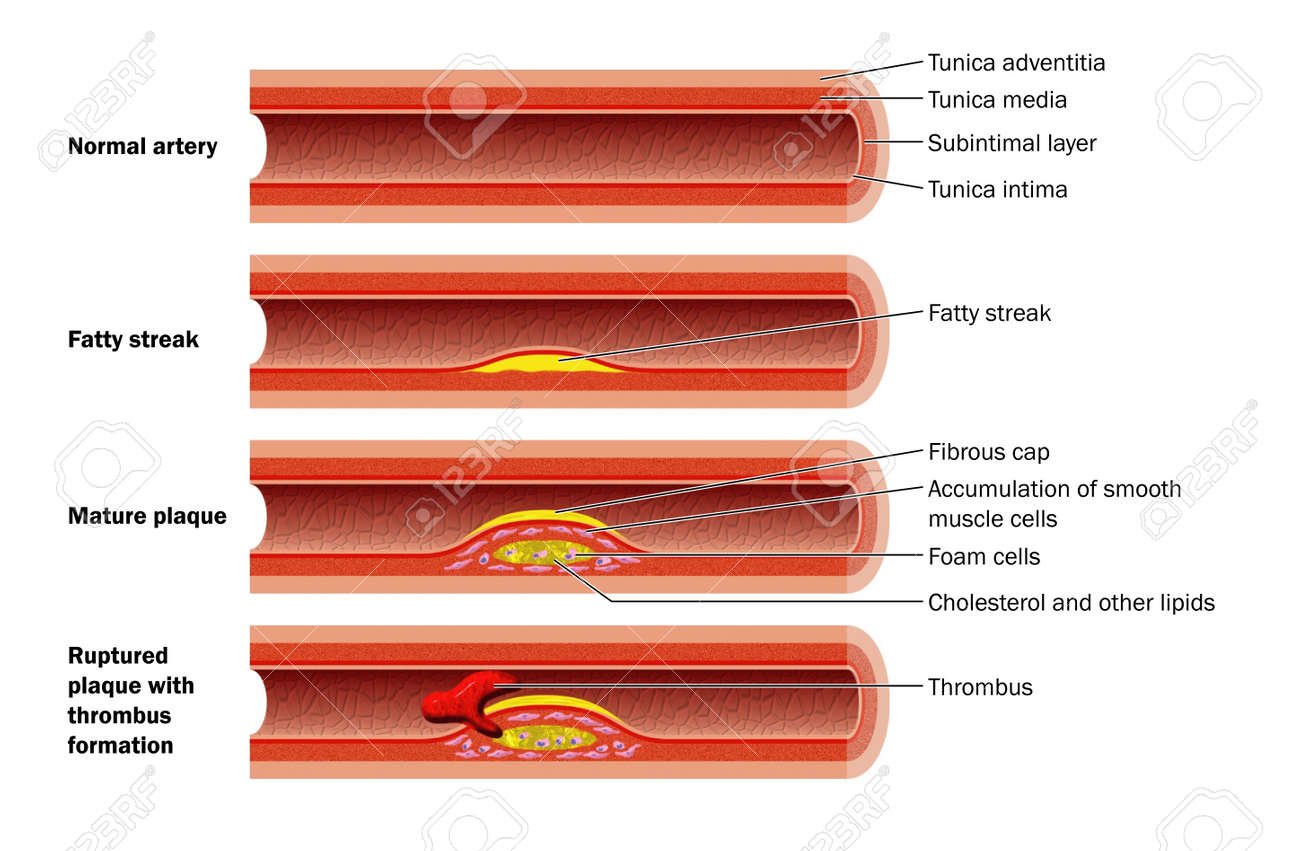 plaque formation in artery royalty free cliparts vectors and stock how does plaque form