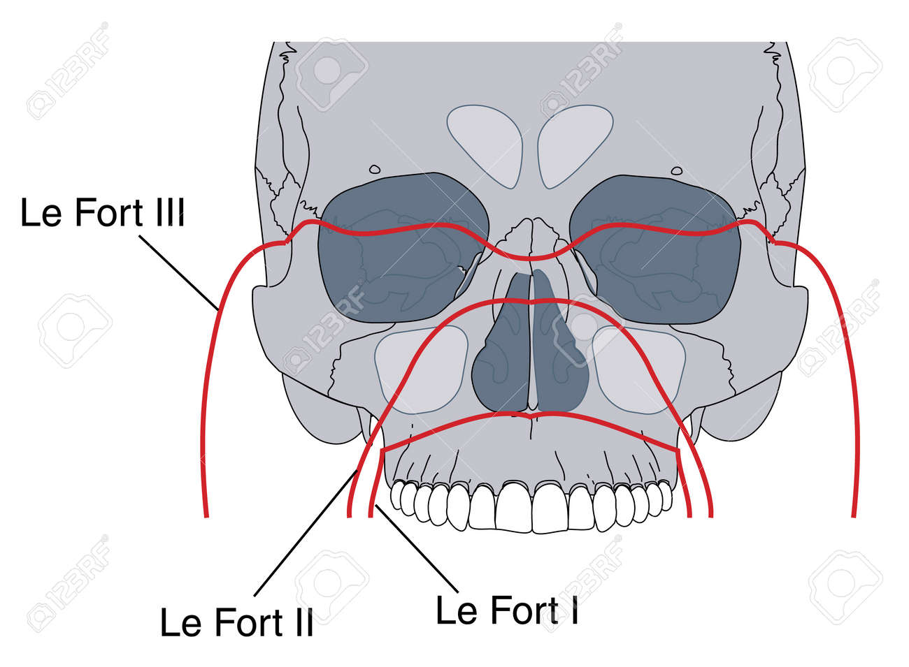 lefort fracture
