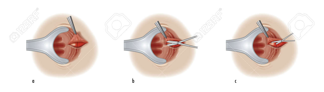 anal sphincter surgery Wifes in porn theaters