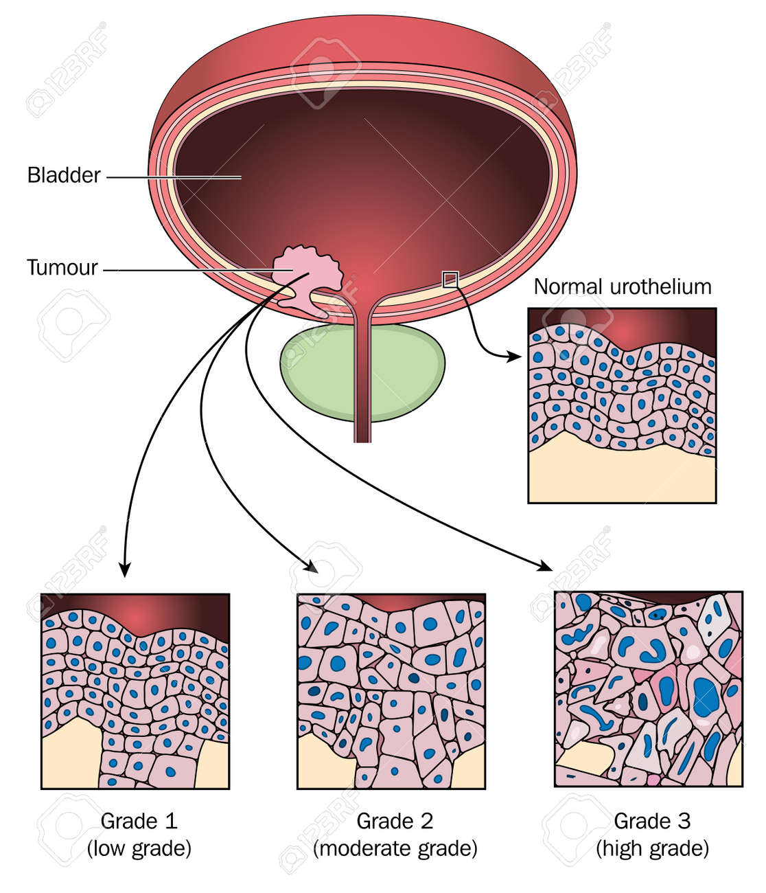 膀胱壁 膀胱癌の 3 段階から細胞と比較して通常尿路上皮細胞の腫瘍 Adobe Illustrator で作成されます グラデーションの塗りが含まれています Eps 10 のイラスト素材 ベクタ Image