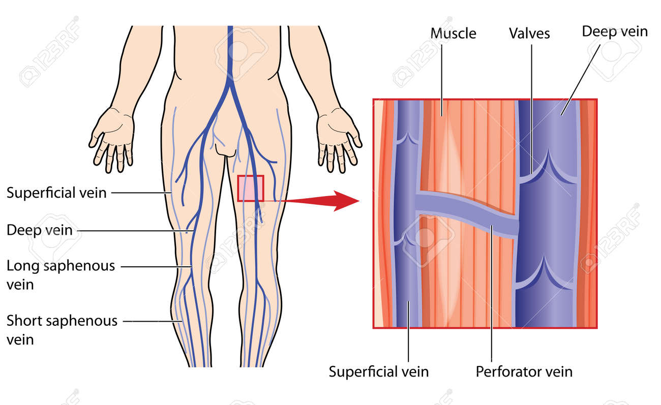 venas en piernas