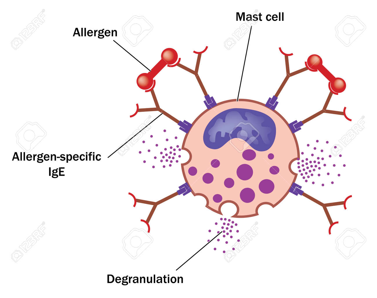 allergen bound to allergen specific ige on a mast cell resulting mast cell degranulation