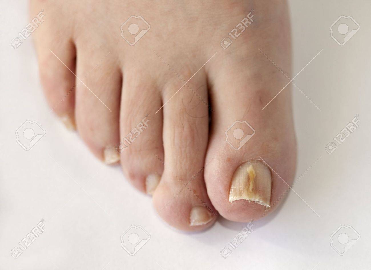 Pied à une infection fongique des ongles orteil