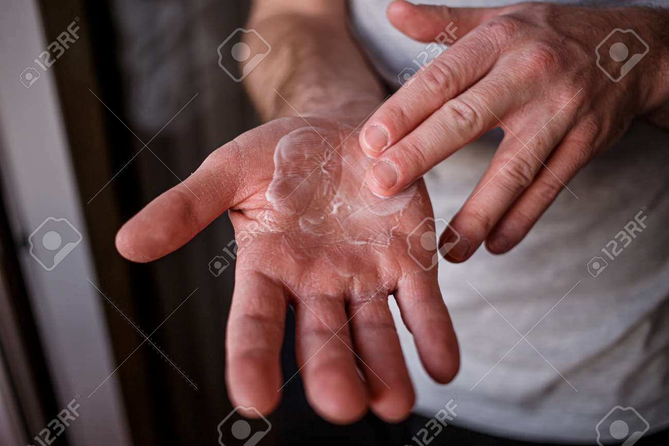 cream for hand cracks