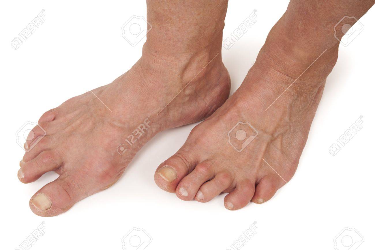 arthrite des pieds
