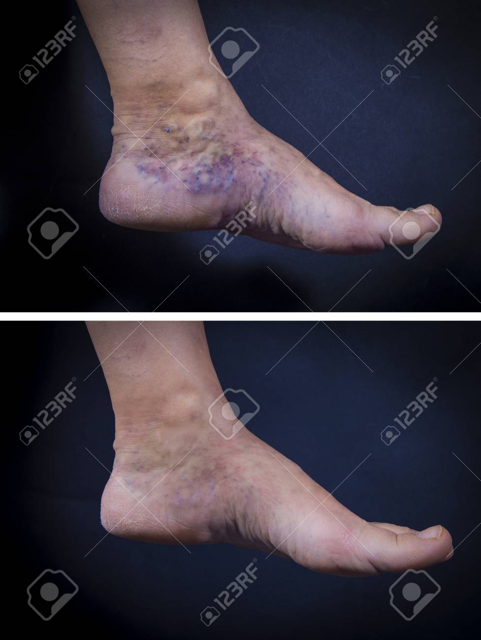 varicose foot pictures fotografie